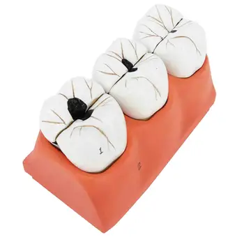 PVC האנושי שיניים שיניים מודל חינוך מטופל מודל עששת טיפול מודל המחלקה לרפואת שיניים תצוגה