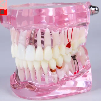 שיניים המודל שיניים Typodonts שתל דנטלי מחקר ניתוח הפגנה שיניים דגם #2001 עם שיקום ורוד